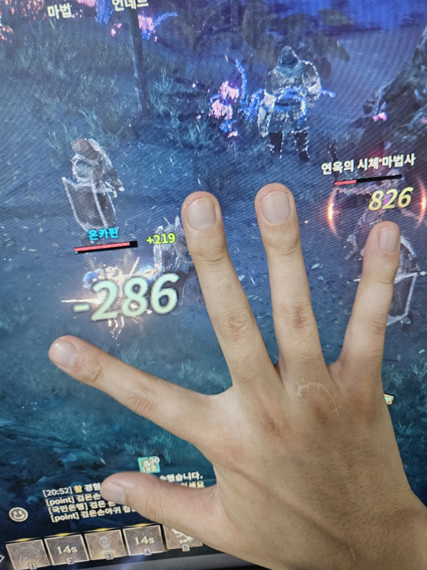 구멍단 손톱 사후 인증합니다★(1)